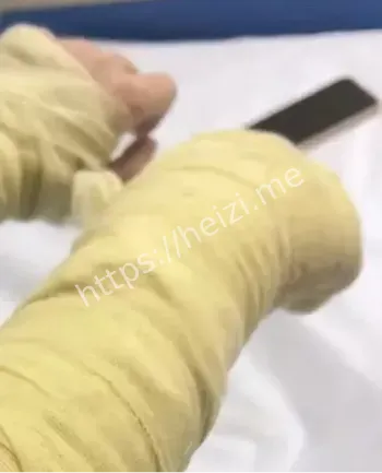 面部深二度烧伤